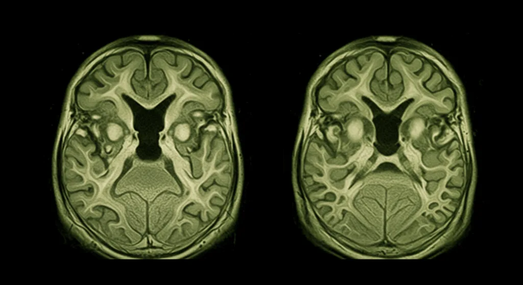 Damaged brain vessels with blurred gray tones and collapsed vessel structures, detailed white matter change patterns as seen in MRI, high contrast minimalist style conveying urgency without text elements