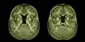 Damaged brain vessels with blurred gray tones and collapsed vessel structures, detailed white matter change patterns as seen in MRI, high contrast minimalist style conveying urgency without text elements